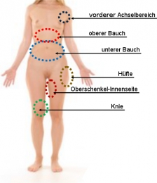 Nur einige der Zonen auf der Körper-Vorderseite bei welchen die Kryolipolyse erfolgreich eingesetzt werden kann.